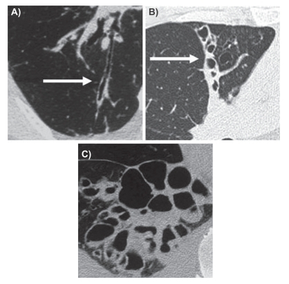 Figure 1 HRCT examples of Reid’s three forms of bronchiectasis: A) tubular B), varicose, and C) cystic.