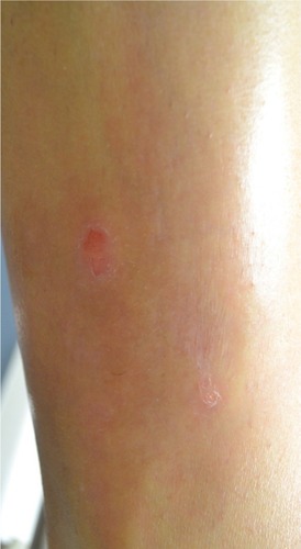 Figure 2 Plaque type psoriasis on lower extremity after eight treatments with excimer laser according to MED protocol.