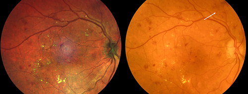 Figure 1 MFI and CFP of a patient with diabetic retinopathy. The white arrow shows an example of hemorrhages and microaneurysms that are more clearly visible and delineated on CFP.