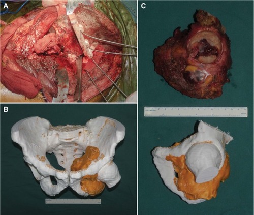 Figure 2 3DMMI-based 3D-printed PSI helped achieve precise resection.Notes: (A) Intraoperative photo showing osteotomy with PSI. (B) A 3D-printed pelvic model, derived from the 3D-multimodality images, providing intraoperative visual and haptic perception of the surgery. (C) The resected specimen was in high conformity with the simulated surgery, both with 3D-multimodality image-based PSI.Abbreviations: 3DMMI, 3D-multimodality images; PSI, patient-specific instruments;
