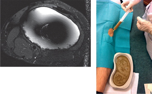 Figure 3. Images from a 25-year-old man who had undergone distal femoral replacement 1 year earlier due to a primary bone tumor. He had a swelling in the region of the operated knee. Axial view showed a thin-walled cystic pseudotumor with liquid-like low signal intensity (left panel). Aspirations were repeatedly negative for bacterial growth and showed the typical appearance of metal reaction (right panel).