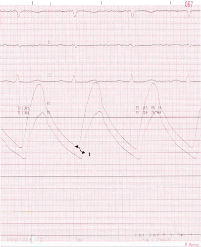 Figure 1. The pressure curves obtained from the ascending aorta (P1) and the femoral artery (P2) (t, transit time).