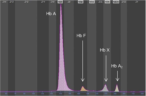 Figure 1. The CE result for the proband shows the Hb X fraction, which corresponds to the hemoglobin Santa Ana peak.