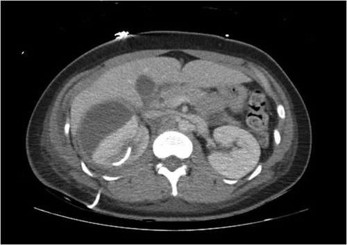 Figure 2. Repeat CT Abdomen with intravenous contrast showing growing perinephric collection (arrow) and resolved prior kidney cyst.