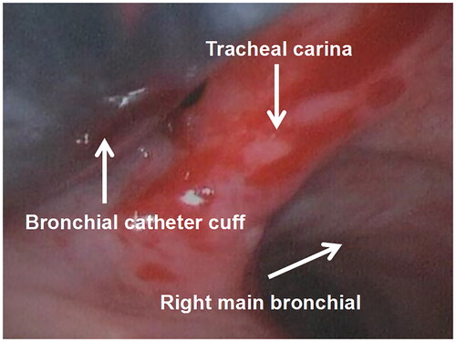 Figure 7. This is a Photograph of the tracheal mucosa of the patient in group I. it can be seen that the cuff end of the DLT is displaced outward, and the carinal mucosa is damaged, bleeding, and edema due to repeated catheter displacement.