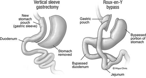 Figure 2 Commonly performed metabolic and bariatric procedures performed in adolescents.