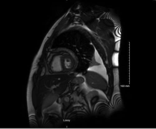 Figure 1. Diffuse thickening of the pericardium with the maximal pericardial thickness. Adjacent to the right ventricular free wall measuring approximately 1.2 cm