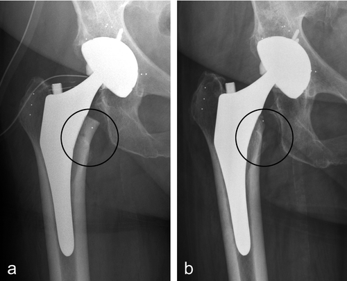 Figure 2. An ABG II hip prosthesis postoperatively (a) and at 24 months (b). Bone loss in Gruen zone 7 was seen as rounding off of the medial femoral neck (shown with circle).