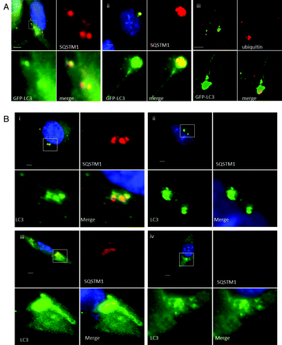 Figure 3. Role of SQSTM1 and ubiquitin in formation of tubulovesicular autophagosomes. (A) CHO cells expressing GFP-LC3 were incubated in nutrient media containing cationic lipoplex for 10 min (i) or 360 min (ii and iii). Cells were fixed and immunostained for SQSTM1 (i and ii), or ubiquitin (iii). Scale bar: 10 μm. (B) Wild-type MEFs (i and iii) or MEFs from sqstm1−/− knockout mice (ii and iv) were incubated with cationic lipoplex. Cells were either fixed at 1 h (i and ii), or 6 h (iii and iv) and immunostained for endogenous LC3 (green) or SQSTM1 (red).