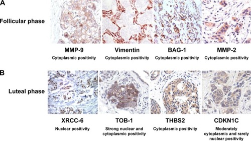Figure 1 Immunohistochemical analysis of paraffin-embedded human breast carcinoma tissues.