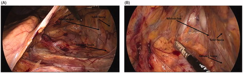 Figure 4. (A) The avascular plane between the Toldt fascia and the Gerota fascia is easily visualized and the dissection may be furthered from above to below along this plane. (B) The avascular plane between Toldt and Gerota fasciae is scored with electrical energy or is mechanically separated through tissue distraction. A whitish line marks the correct route to be followed.