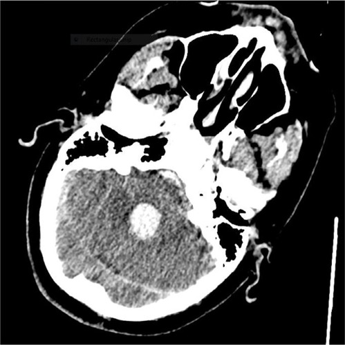 Figure 2 CT of head: Axial image showing hemorrhage extending down into dilated fourth ventricle.