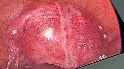 Figure 4 The pregnancy in the left tubal remnant was observed during laparoscopy.