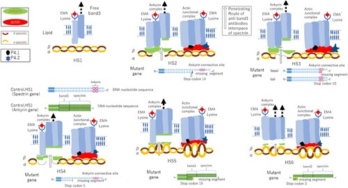Figure 4. Mechanism of low-molecular-weight spectrin, and ankyrin production and loss of these protein complexes from the erythrocyte membrane due to specific gene anomalies observed in six patients with hereditary spherocytosis (HS1–HS6). HS1: Piece of band 3 released from the membrane because of a conformational change in intracellular band 3 during circulation in the spleen. HS2: Stop codon appears at 10 (distal area), and one allele missing seven segments forms the binding site and causes a lack of binding protein. HS3: Stop codon appears at 10 (distal area), and one allele missing seven segments forms the binding site and causes a lack of binding protein. HS4: Stop codon appears at 5 (proximal area) in the DNA sequence, and one allele missing 12 segments forms the binding site and causes a lack of binding protein. HS5: Stop codon appears at 10 (distal area) in the DNA sequence, and one allele missing 14 segments, comprising band 3 and spectrin, causes a lack of protein binding to half of band 3 and all spectrin. HS6: Stop codon appears at 3 (proximal area) in the DNA sequence, and one allele missing 21 segments, which comprises band 3 and spectrin, causes a lack of protein binding to all band 3 and spectrin.