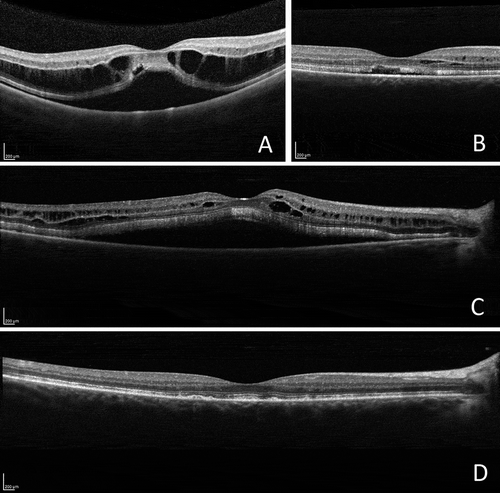 FIGURE 3. Optical coherence tomographic (OCT) images of the right eye. (A) At diagnosis: serous detachment of the neurosensory retina and intraretinal fluid. (B) Exudate decreased following the institution of topical treatment. (C) Recurrence of serous detachment of the neurosensory retina and intraretinal fluid prior to systemic treatment. (D) Exudate regressed after 6 months of systemic treatment.