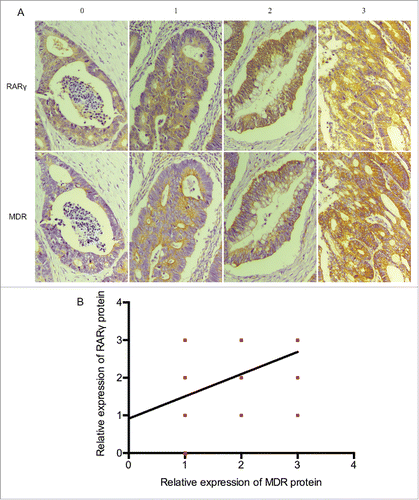 Figure 5. High RARγ are correlated with the expression of MDR1 in human CRC tissues. (A) Representative immunostaining for RARγ and MDR1 shown for 4 patient samples. (B) Correlations between RARγ and MDR1 protein levels in 90 tumor tissues measured.