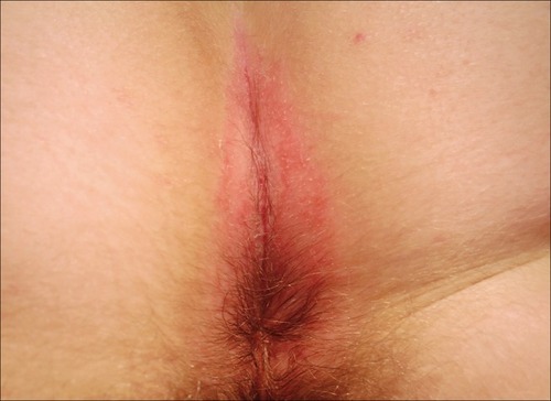 Figure 2 Inverse psoriasis of the perianal area in a 54-year-old woman: symmetrical, erythematous patch with minimal scaling.