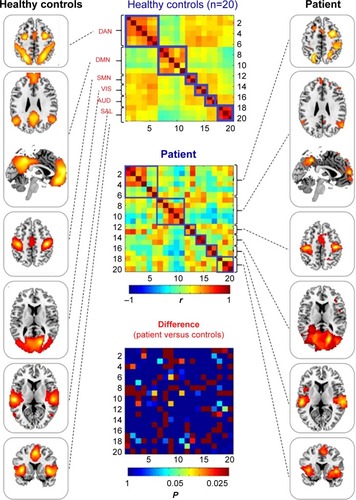 Figure 3 ROI-based large-scale brain networks. Left panel: group average of ROI-based functional connectivity in healthy controls, topographies of large-scale brain networks including dorsal attention, default, somatomotor, visual, auditory, and salience systems from top to bottom. Middle panel: functional connectivity matrices (20 nodes×20 nodes correlation) of healthy controls’ mean (top), patient (middle), and between-group difference in patient versus controls comparison via Z-transformation (bottom, the elements in this matrix have been transformed into corrected P-values, with only P≤0.05 coloring, and P>0.05 colored with uniform dark blue). Right panel: ROI-based functional connectivity in the patient, topographies of large-scale brain networks including dorsal attention, default, somatomotor, visual, auditory, and salience systems from top to bottom.