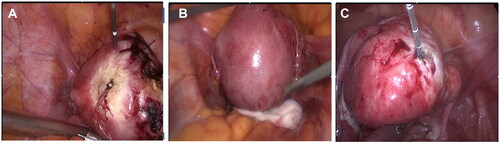 Figure 3. Laparoscope images during ablation. (A) Laparoscope image shows the color changes of the uterine surface; (B) Laparoscope image shows the cotton yarn heat insulation to get a safe space; (C) Laparoscope image shows a clean wound surface during ablation.
