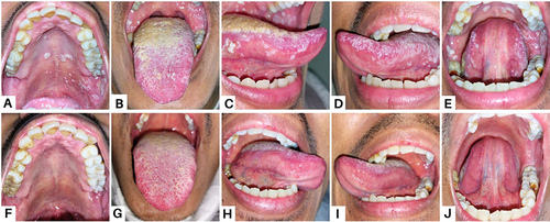 Figure 4 Intraoral lesions in patient Case 4 (A, B, D and E) On the first visit, there were extensive white plaques on the palate and tongue (C) A painful single ulcer with an irregular, yellowish base on the right lateral tongue (F–J) After one month, the lesions recovered.