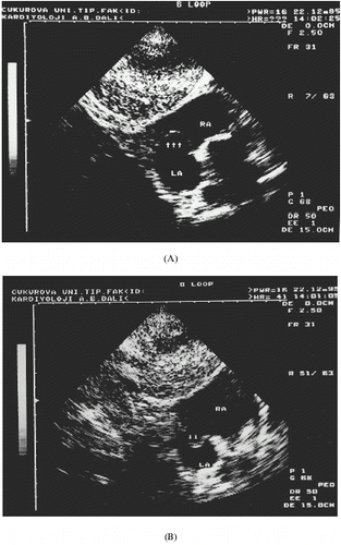 Figure 2. Subcostal view shows atrial septal aneurysm. In (A) the aneurysm (arrows) bulges into the right atrium and in (B) into the left atrium.