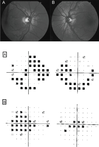 Figure 7 A 55 year old lady carrier of the 3460 G LHON mitochondrial mutation, with bilateral disc swelling (top figure). Automated 24–2 perimetry (middle figure) shows bilateral arcuate defects and 10–2 perimetry shows bilateral central scotomas (bottom figure). The patient is a carrier the 3460 G LHON mitochondrial mutation.