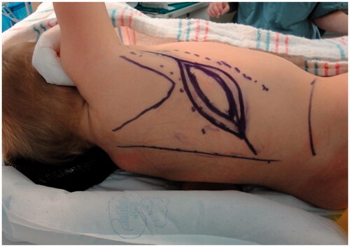 Figure 3. Preoperative markings for a left latissimus dorsi flap with skin paddle.