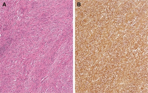 Figure 3 Case 2 GIST surgical resection pathology findings.
