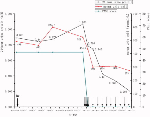 Figure 3. The first time secukinumab application was on 18 March 2021. Here is the change in the urinary protein, serum uric acid and PASI score (vertical thick arrow with Bx: the date of kidney biopsy; vertical thin arrows: the date of every dose of secukinumab).
