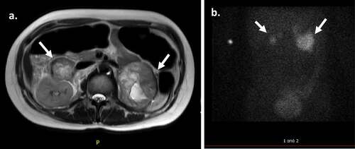 Figure 1. Α) Abdominal MRI in a 33-year-old patient with MEN 2A, indicative of bilateral hemorrhaging pheochromocytomas (arrows). Β) Further imaging of the tumors with 123Ι-ΜΙBG scintigraphy revealed bilateral pheochromocytomas without active bleeding or extraadrenal localization (arrows).