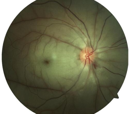 Figure 1 Fundus photograph of the right eye at presentation showing typical features of central retinal artery occlusion (CRAO). Peripapillary axoplasmic ring with peripapillary hemorrhages, white ischemic retina, attenuated arterioles and central cherry red spot is evident.