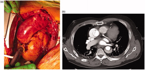 Figure 2. (a) Acute type-A dissection seen intraoperatively with typical appearance where blood can be visualized underneath a thinned out adventitia of the ascending aorta. (b) Preoperative CT scan of the same patient. Photos: Tómas Gudbjartsson.