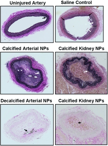 Figure 1 Representative light micrographs of sections (5 μm) of an uninjured (upper left panel) carotid artery from a rabbit inoculated with human arterial-derived nanoparticles, and the injured carotid artery of a rabbit inoculated with saline (control; upper right panel); calcified human arterial-derived (middle left panel) and calcified human kidney stone-derived (middle right panel and bottom right panel) nanoparticles; decalcified human arterial-derived nanoparticles (bottom left panel). All tissue was collected 5 weeks post-inoculation and sections are stained with either elastin van Giesen stain (upper and middle panels) or von Kossa stain (brown-black; lower panels). Sections are shown at the lowest (5X) magnification in order to show the entire artery. Uninjured arteries of rabbits in each treatment group are indistinguishable from that shown. Arrows indicate internal elastic lamina, bar indicates intimal thickening.