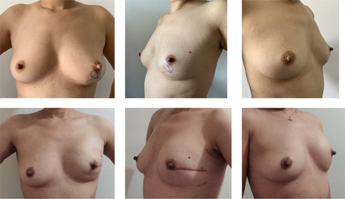 Figure 1 Unilateral, left nipple-sparing mastectomy and one-stage implant-based breast reconstruction with SIS matrix. A 40-year-old woman who was diagnosed with invasive carcinoma and she was treated with neoadjuvant chemotherapy before surgery (above). Photos at 1 year postoperatively (below).