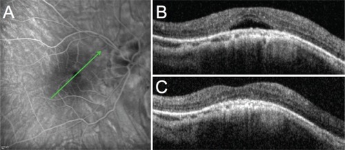 Figure 2 Case 2: 54-year-old female patient.