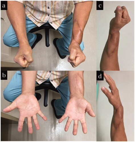 Figure 5. Final appearance and range of motion of case 2. (a–d) Appearance and range of motion at 1 year after the injury.