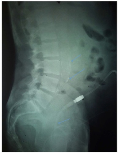 Figure 2 Linear calcification of the descending aorta.