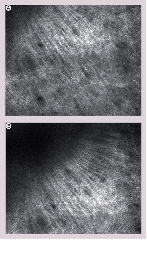 Figure 3. Representative reflectance confocal microscopy images of a hypertrophic scar after basal cell carcinoma excision.The formation of the collagen along the same axis resembles the arrangement of tumour cells in basal cell carcinoma (streaming).