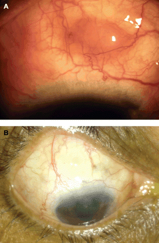 FIGURE 2  Photograph showing nodular scleritis in the right eye (A) and its resolution with treatment (B).