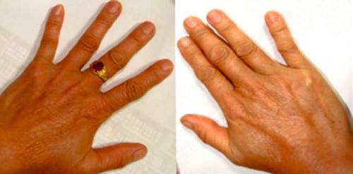 Fig. 3.  Photograph displaying the fingernails of the 48-year-old female patient. This photograph was taken approximately 7.5 years after her Bajiaolian poisoning. Comparison with Figs. 1 and 2 does not reveal any discernable change in fingernail length. The nails had not been cut.