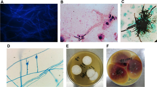 Figure 2 Yeast forms of Penicillium janthinellum in BAL washings stained with fluorescence (A, Original magnification X 400), Gram stains (B, Original magnification X 1000), hexamine silver (C, Original magnification X 400) and fungal morphology stained with medan lactate (D, Original magnification X 400). Colony morphology in the obverse side was cultured in 28 °C PDA medium for 5 days (E) and Colony morphology in the reverse side (F) was cultured in 28 °C PDA medium for 14 days.