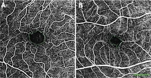 Figure 3 Variability in size of the FAZ in healthy patients. In these nCPM images from 2 of the 37 eyes of healthy subjects, FAZ area and diameter, respectively, are: 0.156 mm2, 545 μm in a 33-year-old male (A); and 0.078 mm2, 394 μm in a 30-year-old male (B).