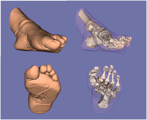 Figure 7. Images created from the 3D-CT data of the affected foot postoperatively. The rotational deformity is corrected, and the sesamoid is properly repositioned postoperatively.