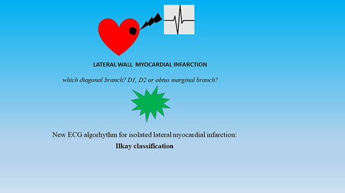 Figure 3 Isolated lateral wall myocardial infarction according to diagonal branches (D1 or D2) and the obtuse marginal has not been clearly identified as electrocardiographic classification. Therefore, there is a need for a new electrocardiogram (ECG) interpretation to accurately predict acute occlusion involving lateral part of ventricle.
