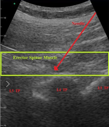 Figure 1 Ultrasound image of ESPB.