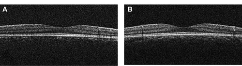 Figure 4 Case 1: optical coherence tomography showed that the foveal architecture was preserved in both eyes.