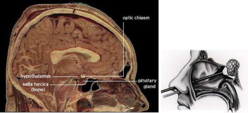 Figure 1. Anatomy of pituitary gland area (adapted from reference Citation[1]) (left); and a schematic demonstrating endoscopic pituitary surgery (adapted from reference Citation[2]) (right).
