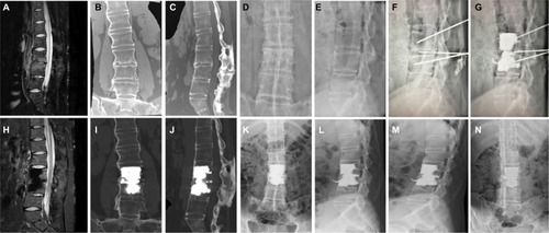 Figure 1 Adjacent vertebral stress fracture with intervertebral pseudarthrosis formation of the L3–L4 segment owing to AS in a 32-year-old male pre and post PIF.