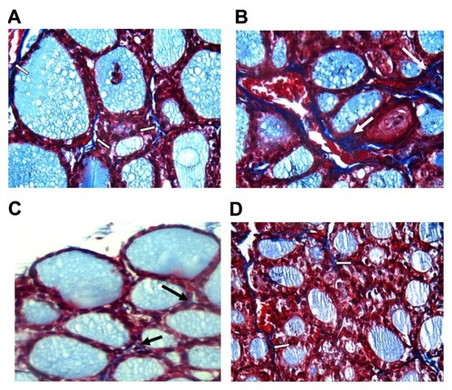Figure 3 (A–D) Comparison of collagen deposition in thyroids of control and treated rats at high magnification power (Masson’s trichrome, 40×).Notes: (A) In thyroids of group 1, collagen (arrow) is minimally present within the gland. (B) In thyroids of group 2, collagen deposition (arrow) increased compared with those of group I. Group 3 (C) and group 4 (D) showed little collagen deposition compared to thyroids of group 2, as they nearly returned to normal.