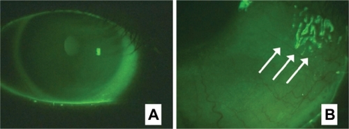 Figure 3 Staining patterns of wheat germ agglutinin conjugate of fluorescein (F-WGA) on the ocular surface observed using a slit-lamp biomicroscope equipped with a blue-free barrier filter. A) The corneal surface was stained by F-WGA with a faint, diffuse pattern. Staining of the bulbar conjunctiva was more intense than the cornea. B) Tear mucus was strongly stained with F-WGA (arrows).